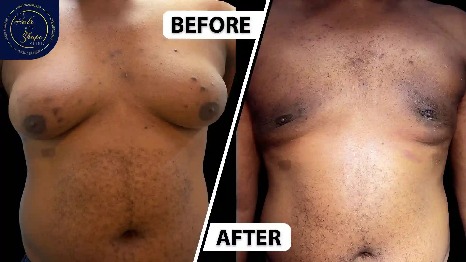 Gynecomastia result6